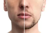 🉐痛くない!メンズヒゲ脱毛11回コース😊