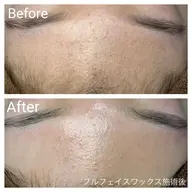 ⭐️選べる3パーツ⭐️艶肌フェイスワックス60分(鼻・眉間・顎・鼻下)の中から選択可能＋お仕上げトリートメント付き