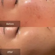 【🩷ニキビ・ニキビ跡・凹凸肌でお悩みの方🩷】ハーブピーリング＋生コラーゲン＋細胞活性化セルサー