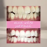 【定額通い放題プラン】セルフホワイトニング1ヶ月¥11000