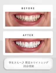 【学生さん必見!】ホワイトニングトリートメント付き🤍