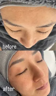 お顔の全顔Wax！お肌の角質から毛を除去して赤ちゃん並みのツルスベ肌！