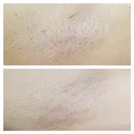 【中学生&高校生だけ！★10分脱毛★両脇】