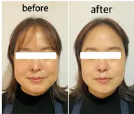 痛くない小顔矯正