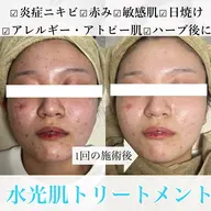 ニキビ撲滅👊🫧‪レストセルトリートメント‪ 《マッサージ有》🫧‪炎症ニキビ/敏感肌/日焼け/アレルギー/アトピー肌