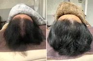 人気①メンズ育毛鍼真剣にお悩みは是非安心プライベートサロン💖18700→今だけ