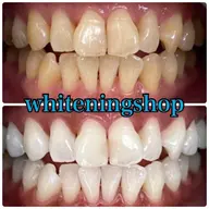 【🌟チラシお持ちの方限定】チラシをお持ちの方はこちらから◎/ホワイトニング