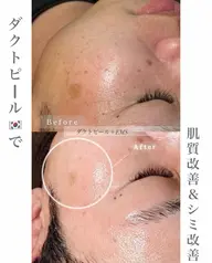 《人気no.1》剥かない最新ピーリング！ララピール進化版ダクトピール／毛穴・シミ・シワ徹底ケア◎