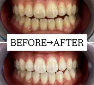 【当日に回数券ご購入の方】初回無料★美白ホワイトニング20分×2回照射が無料✨