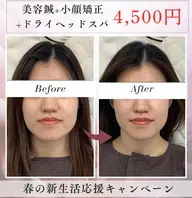 【👑人気No.1👑】美容鍼+小顔矯正+ドライヘッドスパ(60分)