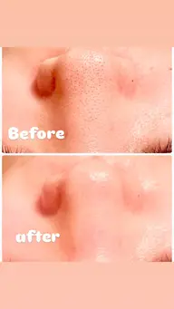 大人気　小鼻ツルツルスペシャルケア