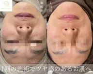 【ワンランク上の毛穴洗浄】1.5倍の洗浄力！毛穴引き締めトリートメント付き