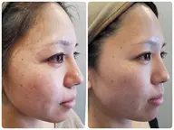 高濃度ビタミンA＋マイクロニードル◎血流トリートメントで引き締め引き上げUP⇧ 今あるニキビの徹底ケアも🌱