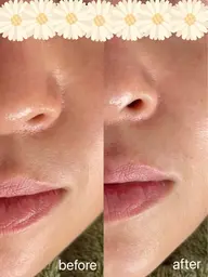 ハーブピーリング