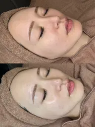 春割🌸✨ミニモ特別価格🌈練習モデル🌱話題のララピール❤️肌を育てる剥離しないピーリング🫧✨全顔施術