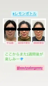 水光肌白玉エステ⭐️小顔韓国美容⭐️エステ版ポテンツァで美容液導入＋筋膜リフト！