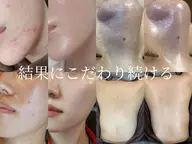 ハーブピーリング✖️小鼻毛穴洗浄付き❤️‍🔥　ヒト幹細胞パックも初回無料♪本日限定60%オフ