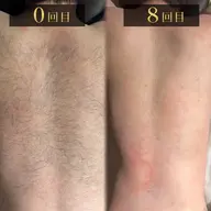 パーフェクト全身脱毛(ヒゲ込/vio無)