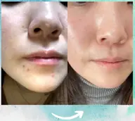 【韓国女優のような陶器肌】❤️つるりん毛穴レス体験❤️［兵庫県尼崎市/痩身エステ］