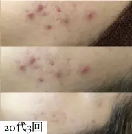 【医療提携サロン】リベルハーブピーリング🌿剥離あり