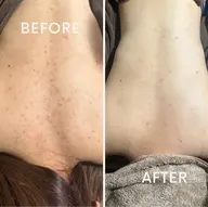 【剥離なし】背中🌿ハーブピーリング