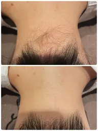 大人気♡うなじ脱毛3回パス