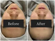 メディカルハーブピーリング🌿(ニキビ・くすみ・毛穴の開きにお悩みの方)