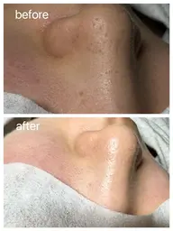 小鼻周り毛穴洗浄×小鼻周りWAX脱毛 🤍🐰 ※月水金は15時にご予約変更する場合あり💦