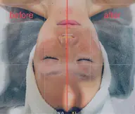 【フェイシャル】小顔美肌コース🎀サーマルFR+美肌パック+肌再生クリームケア＋デコルテ～頭までマッサージ付き 🎀