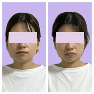 ‼️特別価格‼️小顔美容整骨矯正　　4,500円