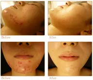 ハーブピーリング