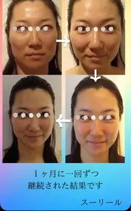 小顔　むくみ顔　疲れ顔　ニキビ跡の悩み　炭酸エステ