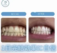 本日23日限定20時半先着1名【1日完結型セルフホワイトニング歯の黄ばみ1日で解決】ワンデー美白ホワイトニング