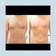 【メンズ全身脱毛（顔込VIO無）＋襟足と背中シェービング付き】¥13000  施術45分　剛毛・日焼けOK/メンズカット