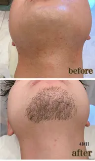 男性👨🦰光髭脱毛🥸