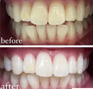 ナチュラルセルフホワイトニング