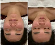 💫韓国美容💫フェイシャル‼️脂肪を溶かすからリバウンドなし✨