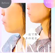 小顔フェイシャル30%オフ