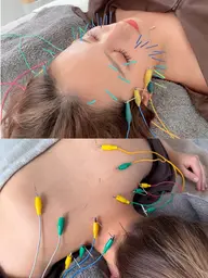 美容鍼＆ボディ鍼灸セット✨