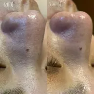 【毛穴詰まり・角栓ごっそり】毛穴洗浄×ヒト幹細胞パックで毛穴レスなツヤ肌へ♡