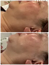 【伏見/小顔】次世代ハンドRFの温熱技術でお顔の土台から引き上げ✨3Dフェイシャル超えの満足度!月2名限定