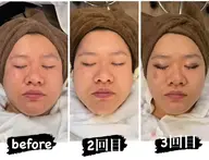 切らない小顔リフト【✨1日1名様限定✨】100push