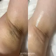 【両脇ワックス脱毛】