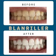 【都度払】口コミ投稿で10%オフ⭐15分×2回(30分照射)¥5000→¥4500🎶とってもお得◎ホワイトニング❤