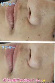 毛穴ケアフェイシャル✨