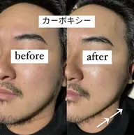 【リフトアップ】カーボキシーパック