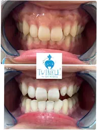 ✨当店おすすめ！セルフホワイトニング　ライトプラン　8分☓3回