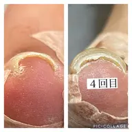 巻き爪ジェル🦶