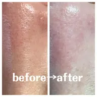 さよならイチゴ鼻。✨毛穴洗浄エステ✨✨