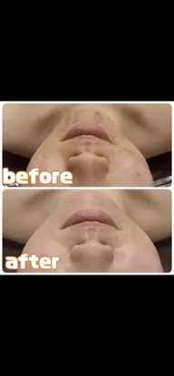 🍓🍷脱毛とフェイシャルのいいとこ取り🍓🍷ピーリング&パック付き❤韓国肌・美白・毛穴・小顔・化粧ノリUP🍓🍷